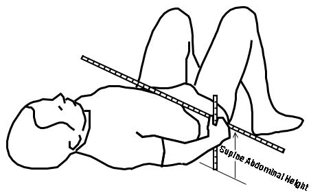 sagittal abdominal diameter