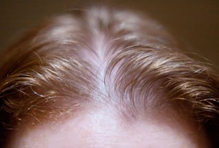 close-up of a thinning hairline in an adult