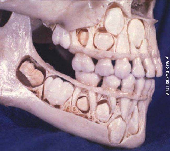 Teeth in a a jaw, ready to be pushed out.