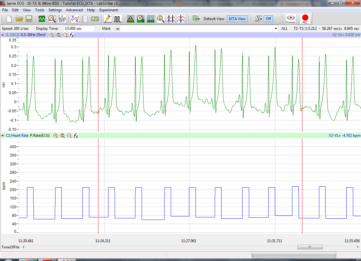 ECG Recording