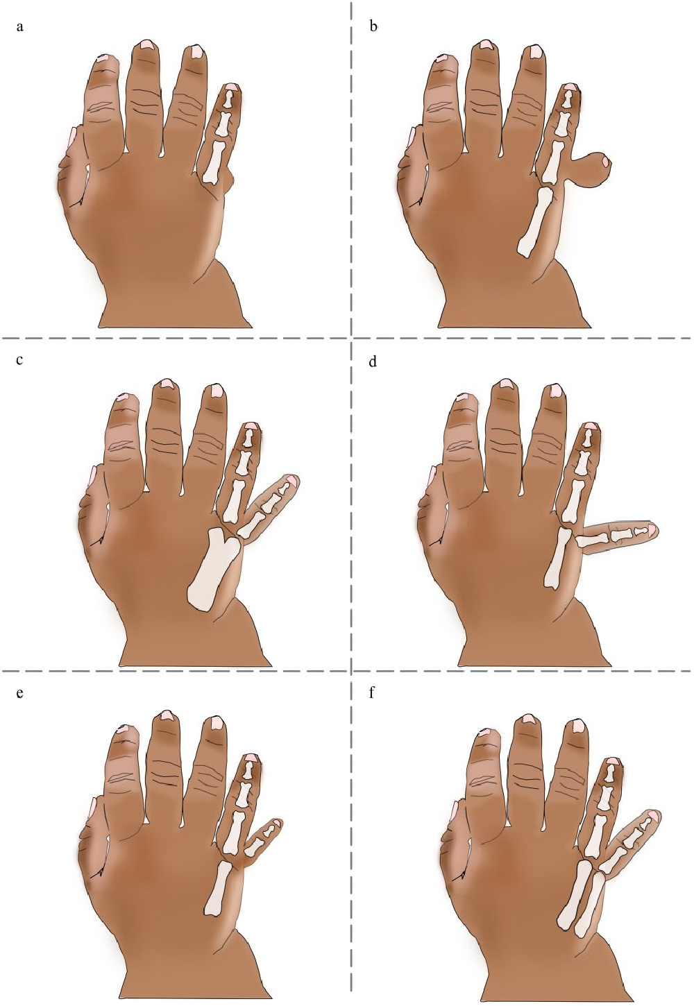 Polydactyly