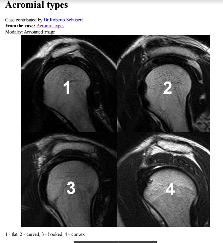 acromion types mri