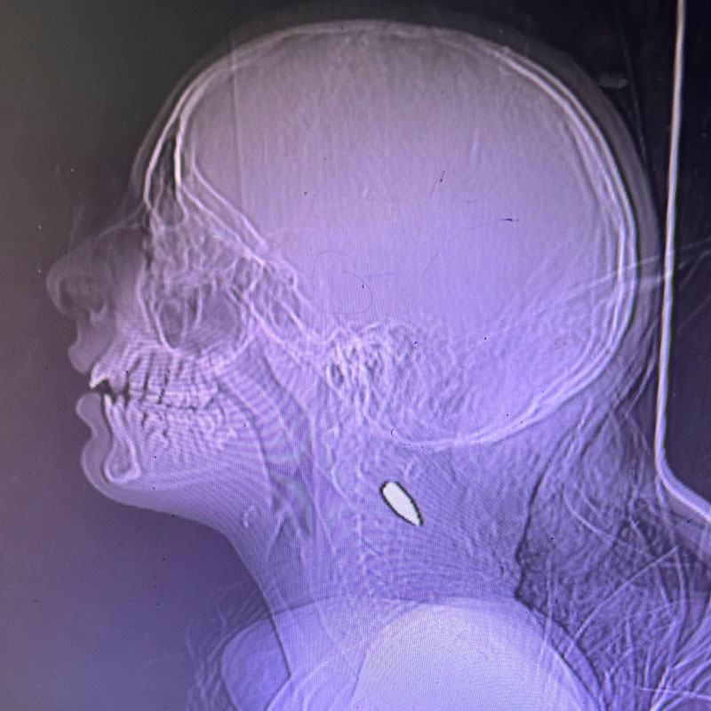 X-ray of a child with a bullet in her neck