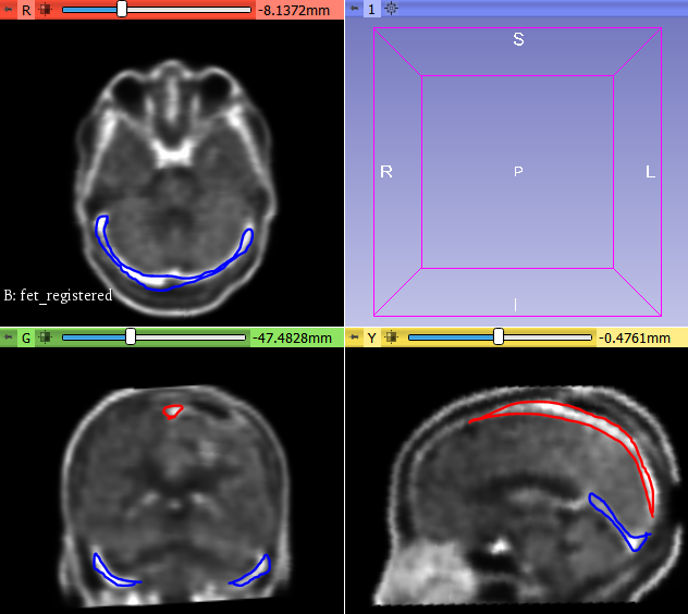 Brain Vessels (vessels are higher intensity)