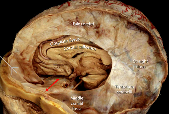 Picture of Falx Cerebri