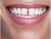 woman's smile showing large gap between the incisors