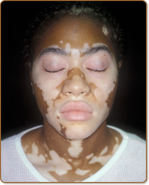 Woman with vitiligo