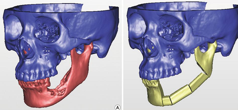 Remove the ill bone and shape a cylinder piece by piece