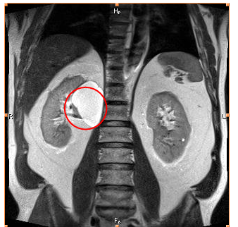 tumor detection