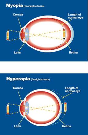 Far and nearsightedness