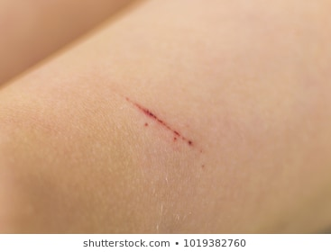 scratched skin by thorn