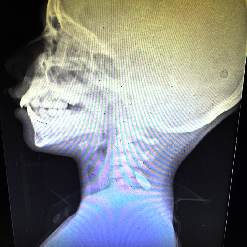 Another x-ray of a child with a bullet in their neck