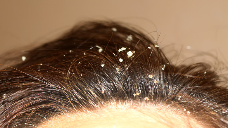 DANDRUFF