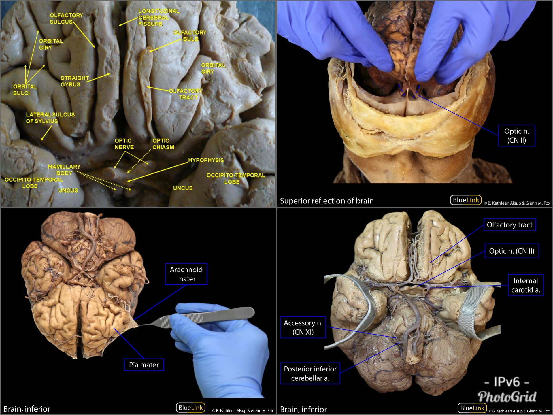 Straight Gyrus