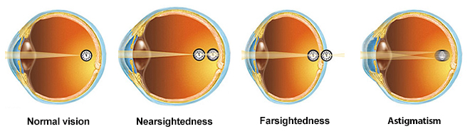 refractive errors