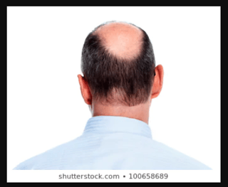 man's extensive bald patch as seen from behind