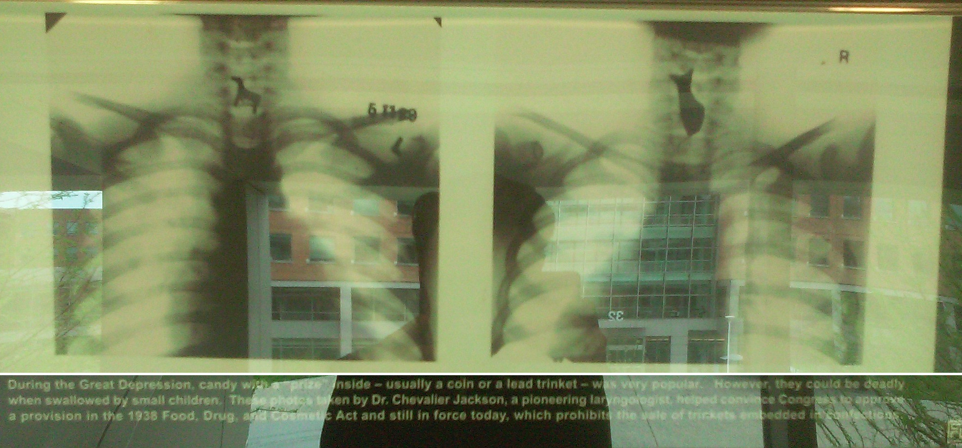 Photo of a poster from the FDA history office showing an x-ray of a toy stuck in a child's larynx