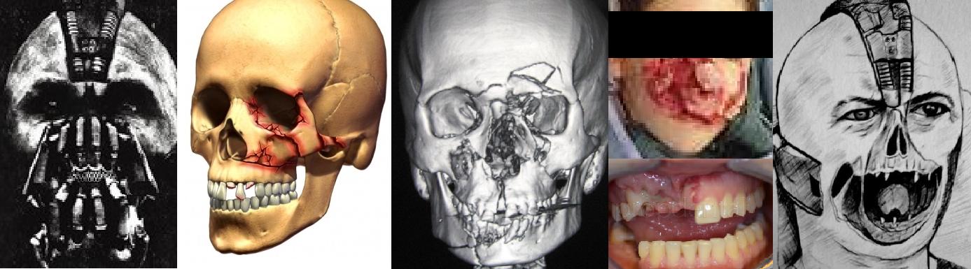 Fractura maxilofacial