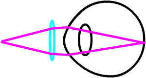 Presbyopia