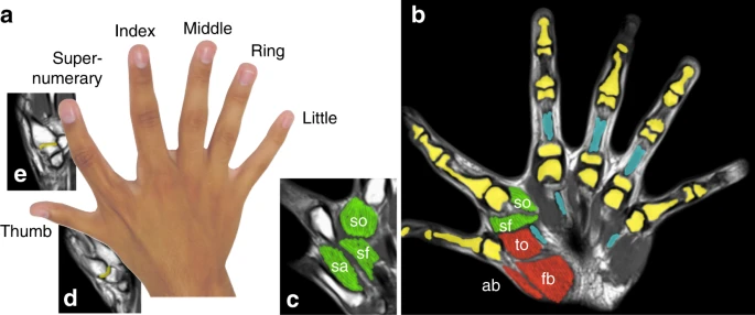 polydactyly