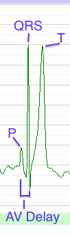 Annotated ECG Waveform