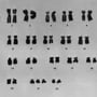 down karyotype