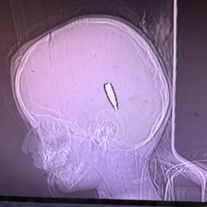 X-ray of a child with a bullet in her head